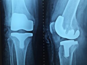 total joint replacement